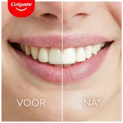 Colgate Max White Ultimate Led Whitening Kit 1 set